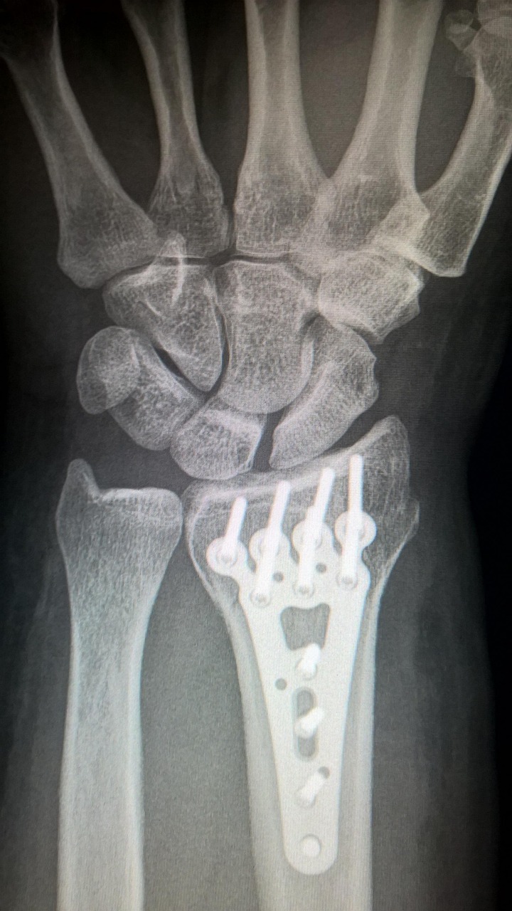 X-Ray